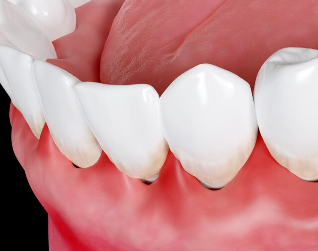 Best Swollen Gums Treatment