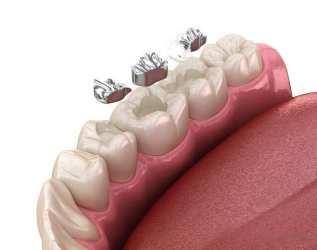 Best Tooth Cavity Restorations