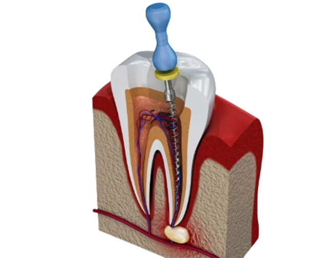 Best Root Canal Treatment In Vizag