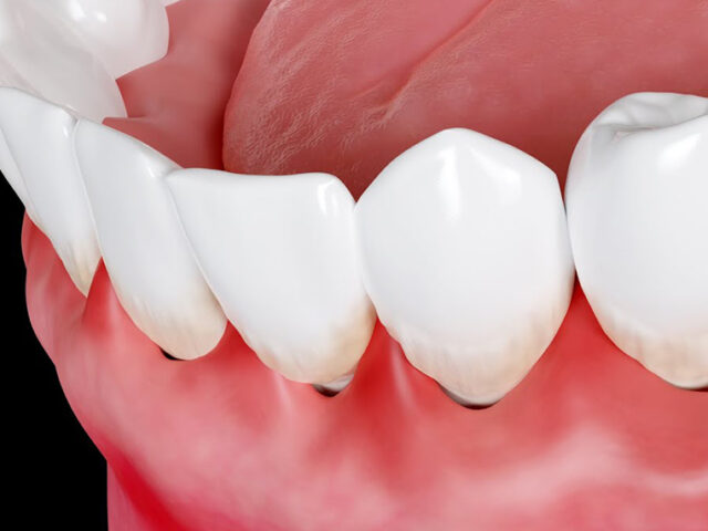 https://www.indudental.in/wp-content/uploads/2019/10/37-640x480.jpg