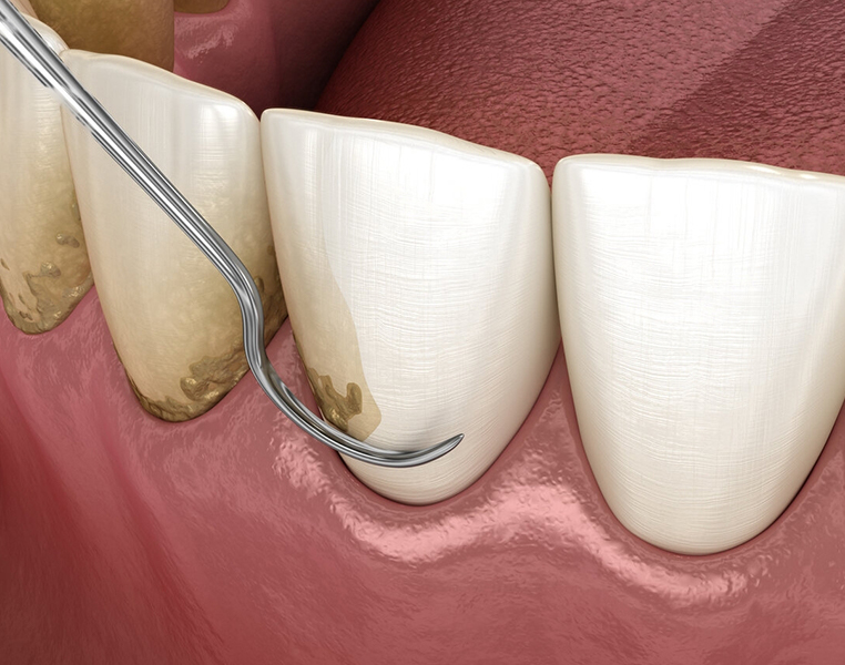 Best Tooth Scaling