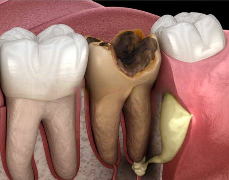 Pus & Abscess Drainage