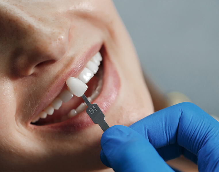 Best Dental Veneers