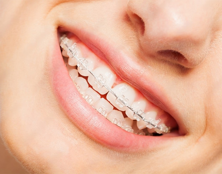 Best ceramic braces in Vizag