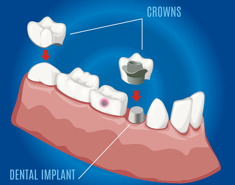 Best Crowns and Bridges