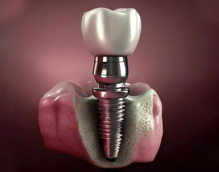 Best Implant Supported Crowns