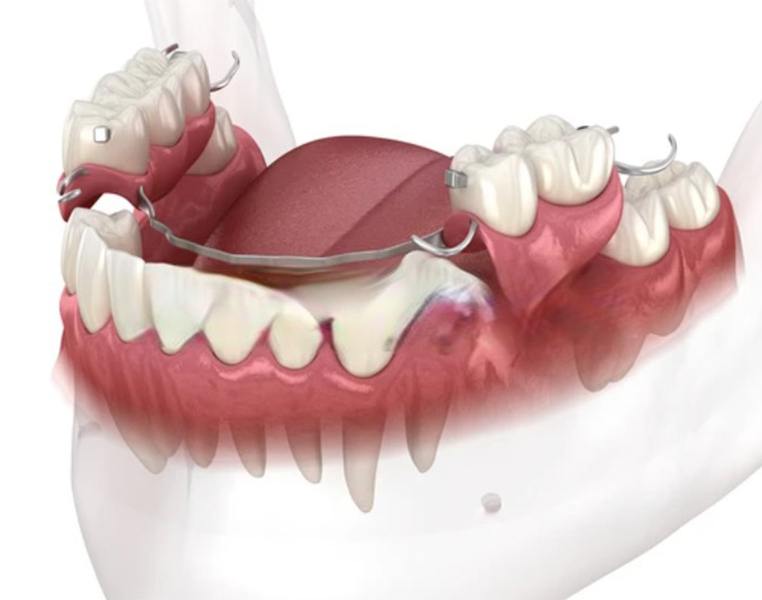 Best Removable Partial Dentures