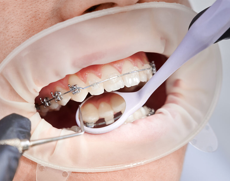 Best Lingual Braces in Vizag