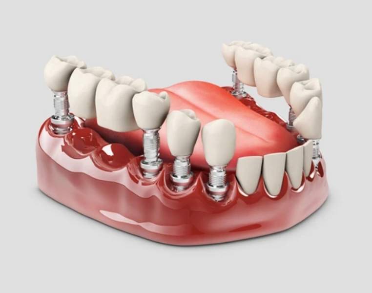 Fixed Partial Dentures