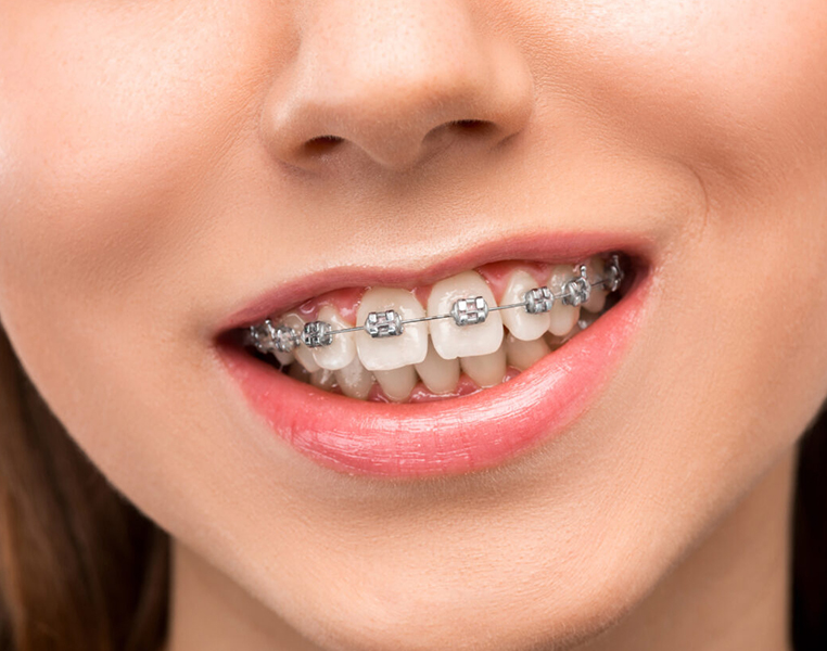 Best metal braces in vizag